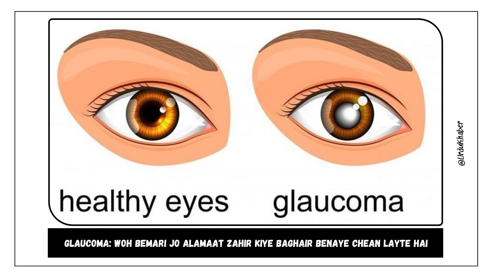 Glaucoma: Woh Bemari Jo Alamaat Zahir Kiye Baghair Benaye Chean Layte Hai