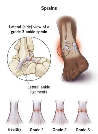 ANKLE SPRAIN